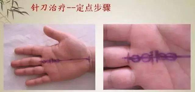 針刀治療屈指肌腱狹窄性腱鞘炎