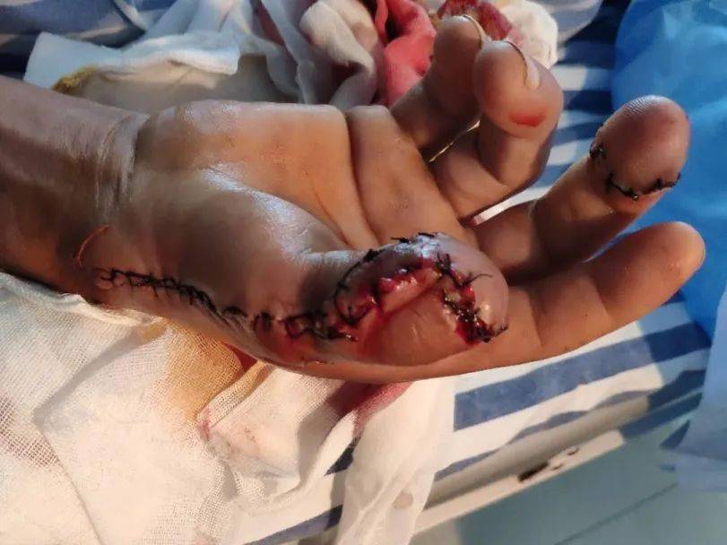 手指重生!我院骨科精准施治拇指桡背侧筋膜蒂逆行岛状皮瓣修复术