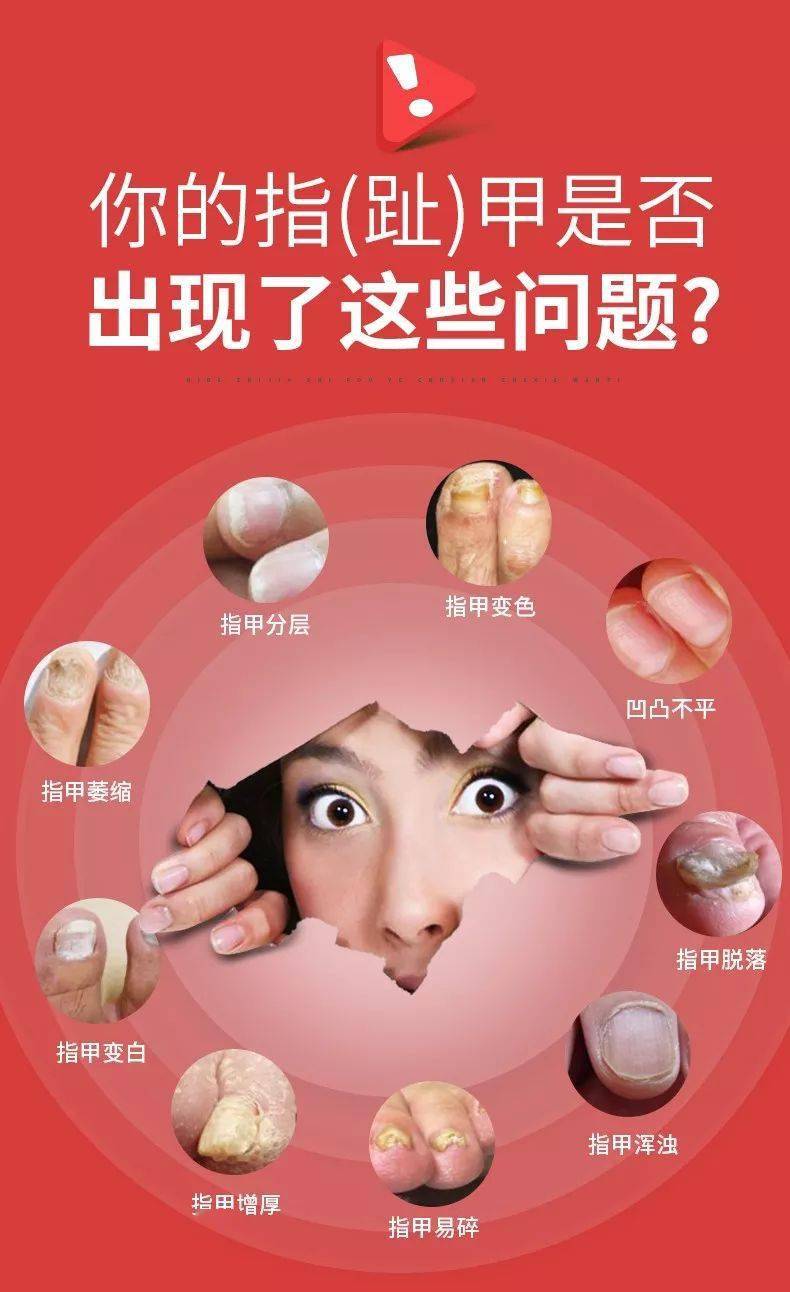 灰指甲患者的重磅福音,7天清除坏指甲,15天还你健康新指甲!