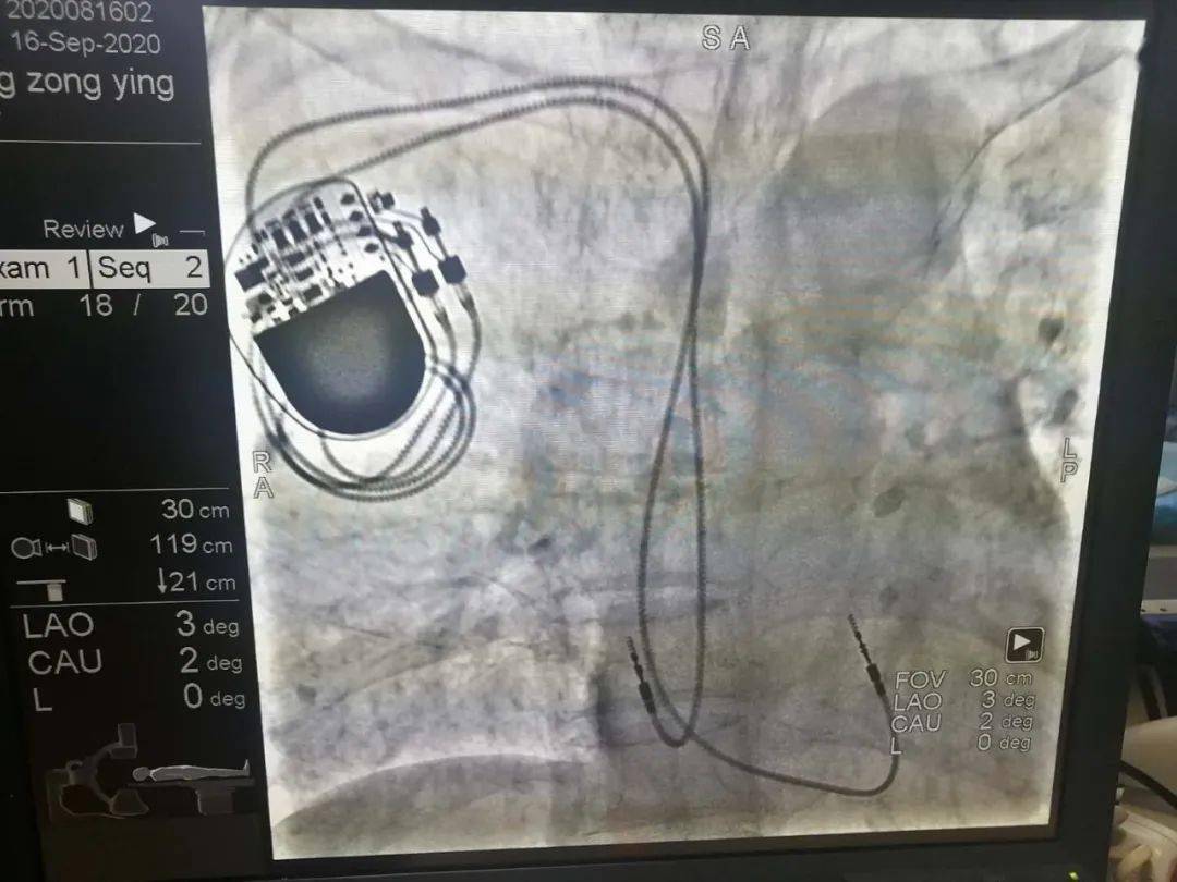 再提升 | 我院心內科獨立完成首例雙腔永久起搏器植入術