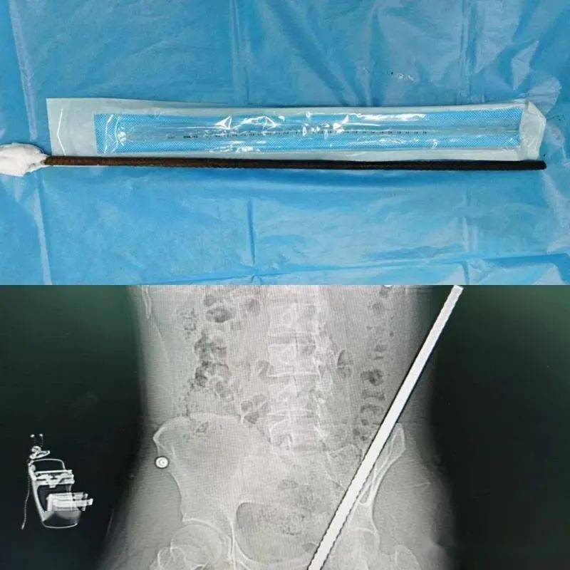 历经十天,钢筋贯穿伤小哥走出icu