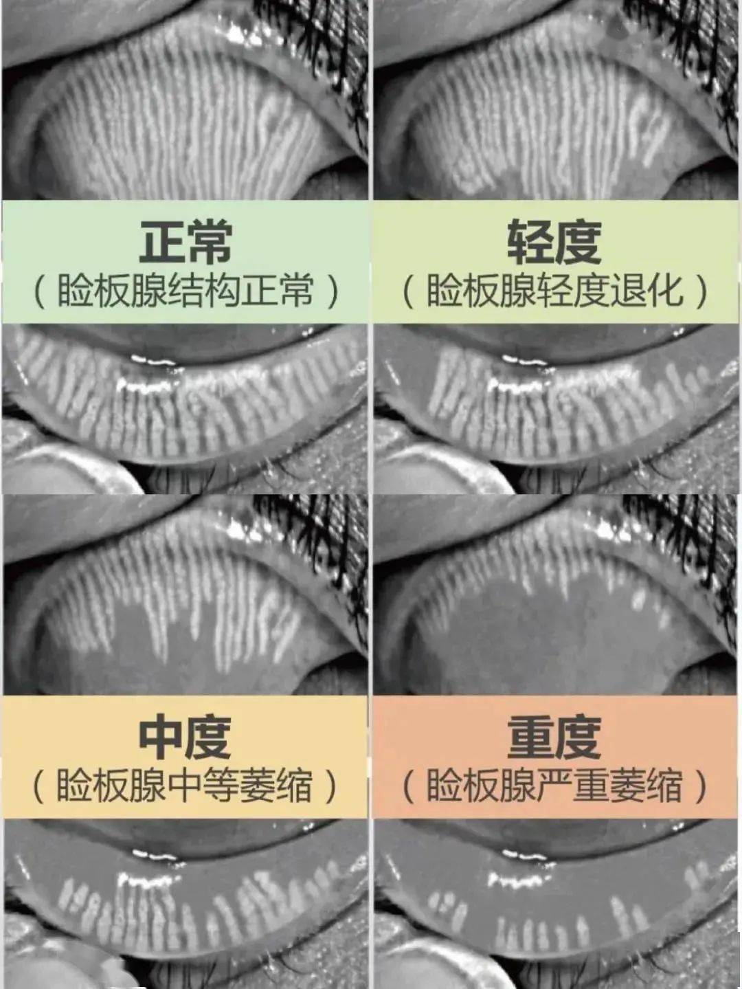 热搜知名艺人眼睛睑板腺消失网友惊呼我好像也是