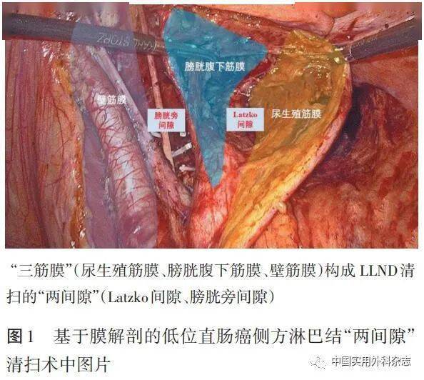 在日本,直腸全系膜切除(total mesorectal excision,tme) 側方淋巴結