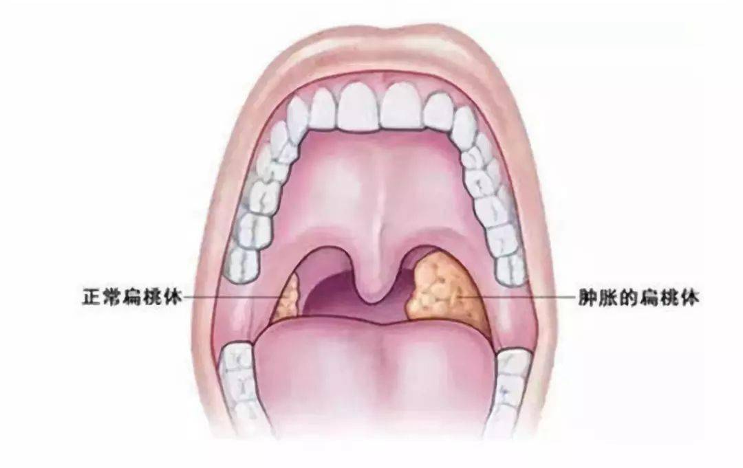 咽扁桃体位置图解图片