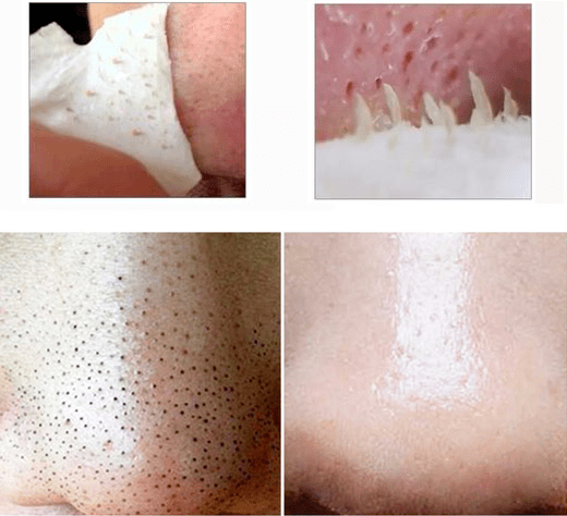 10倍放大亲眼目睹黑头被掏空画面极度舒适