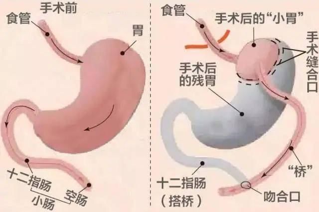 市二医院微创减重手术摆脱肥胖症和糖尿病的福音