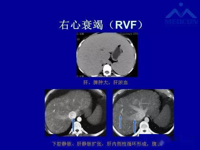 干货门静脉高压分型及影像学特征