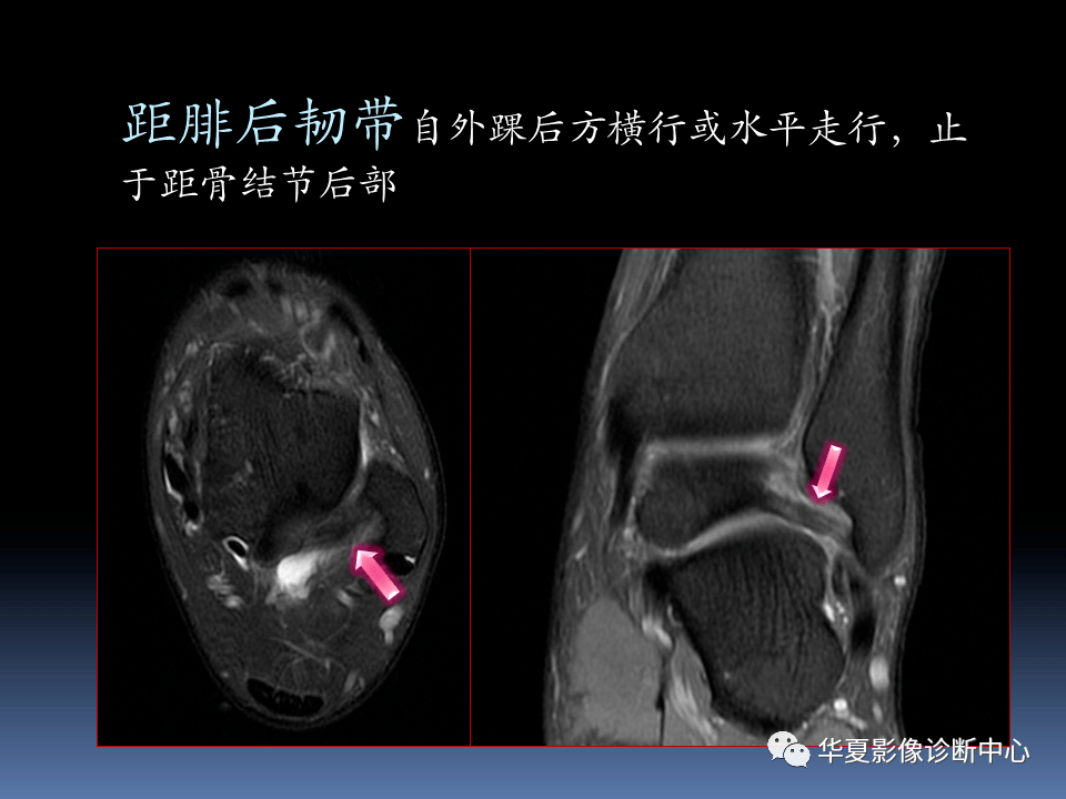 脚踝韧带核磁共振图片图片