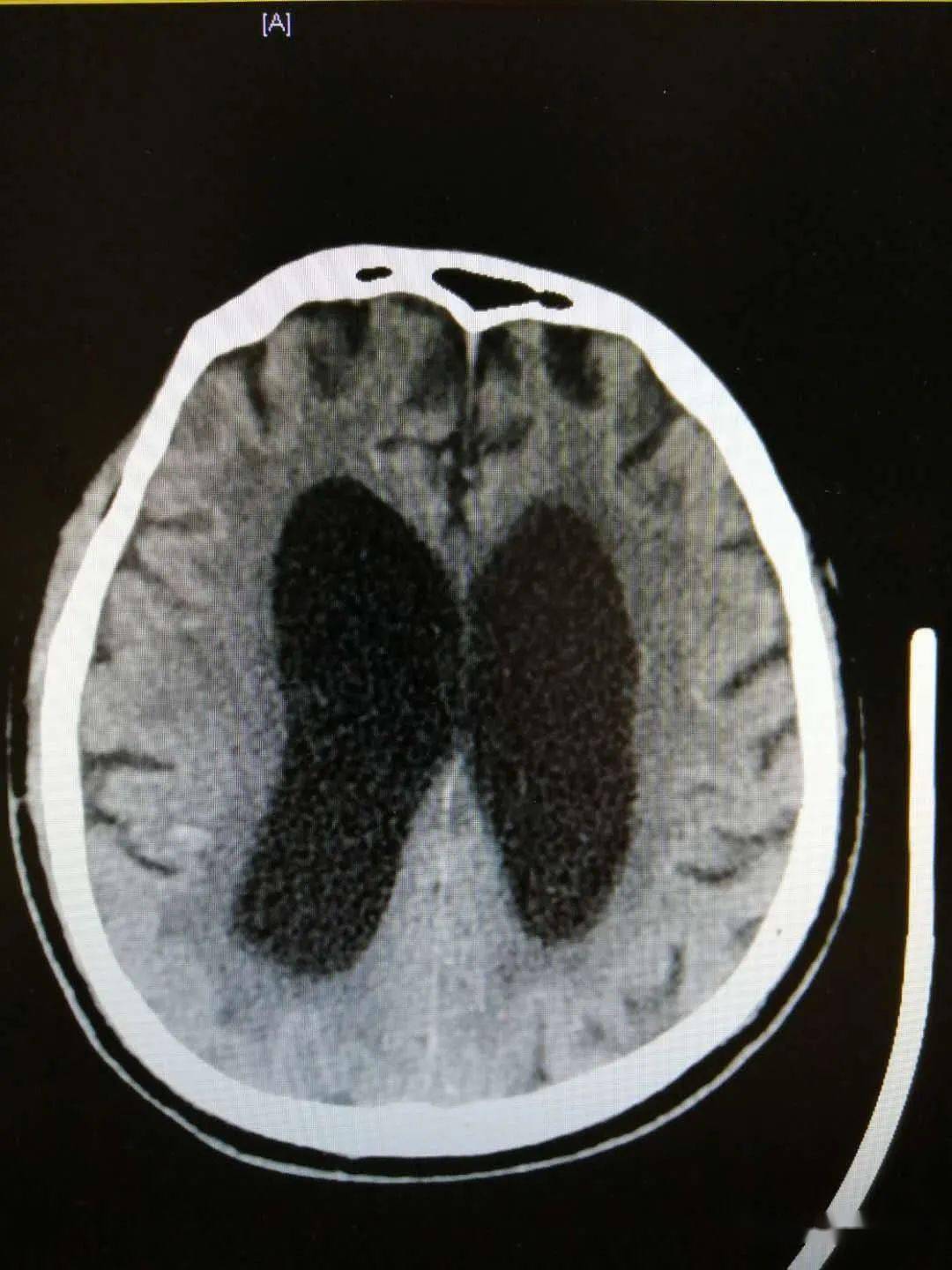 步态不稳反应迟钝老年痴呆不一定当心脑积水