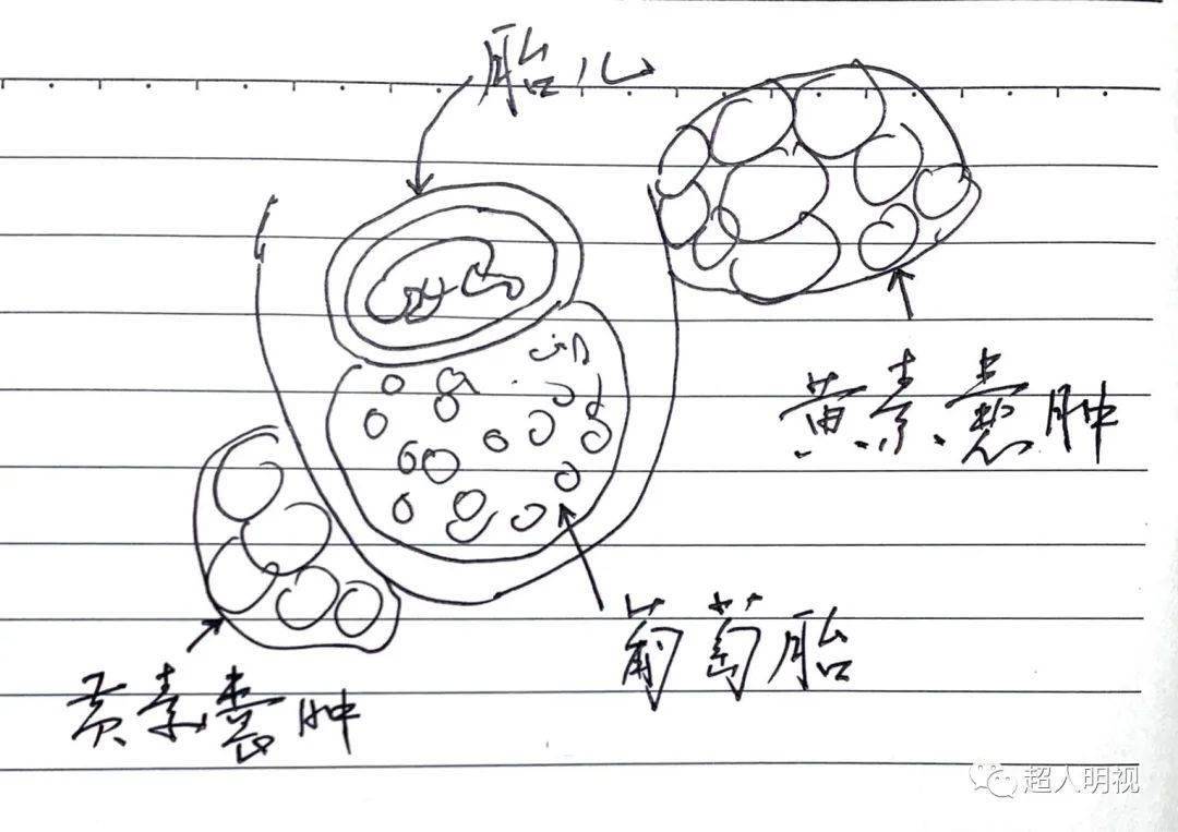 葡萄胎镜下图片手绘图片