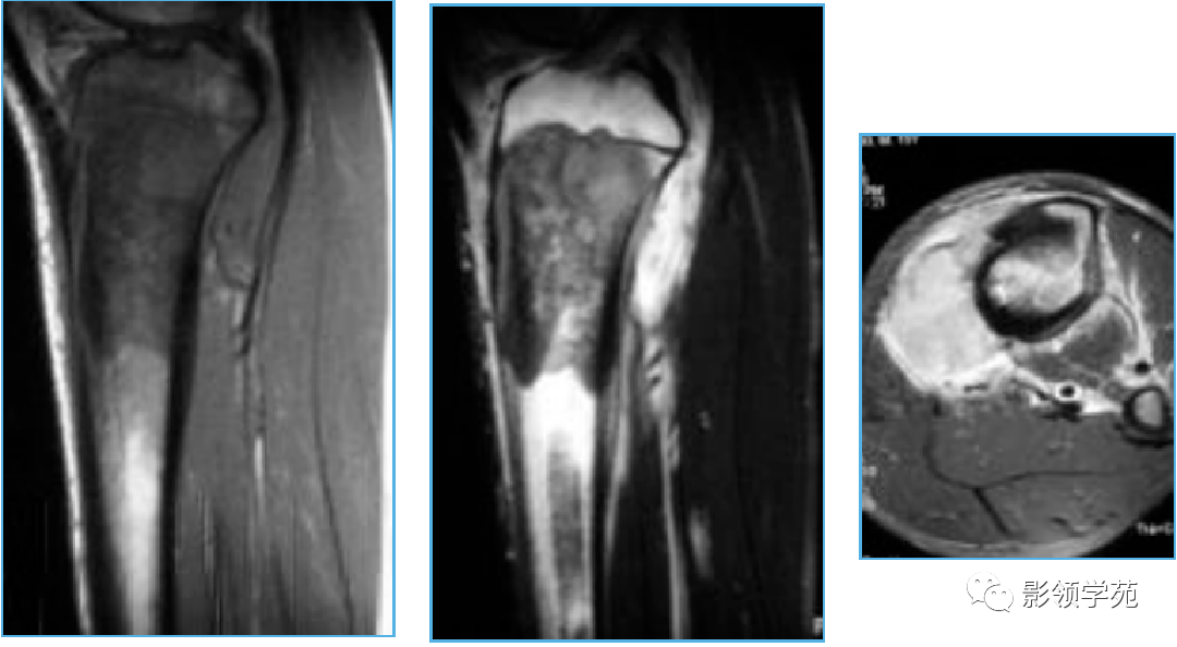 10种类型骨肉瘤影像学诊断