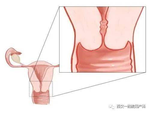 宫颈锥形切除术图片