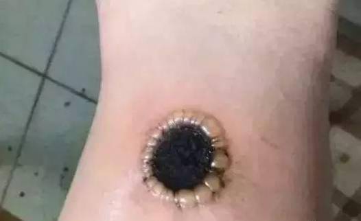 直接灸产生的灸花这样说吧,如果你的病情比较紧急,直接灸的带来些许