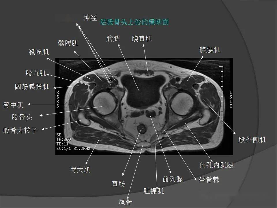 骨盆肌肉mri断层解剖