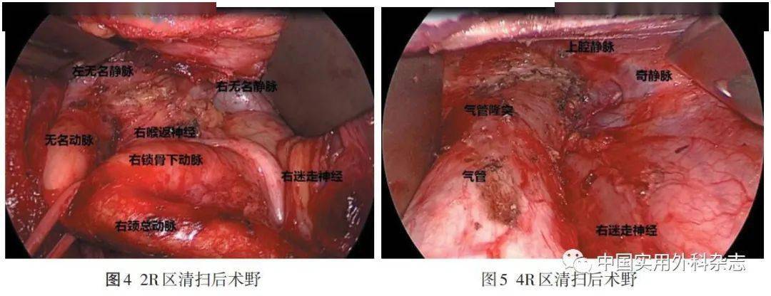 術式討論腔鏡下甲狀腺癌上縱隔淋巴結清掃技術要點