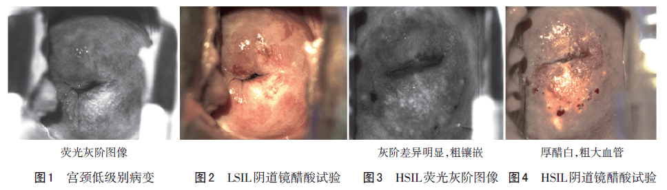 新型固有荧光灰阶图像诊断技术与阴道镜诊断子宫颈疾病的比较研究