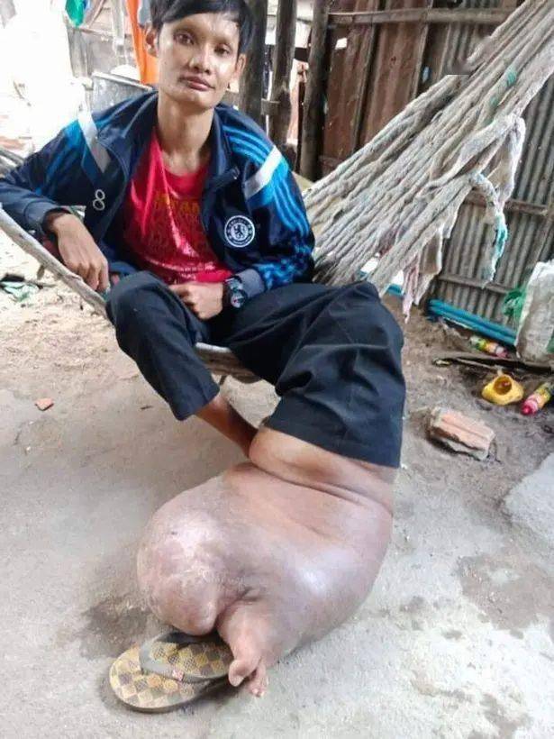 柬埔寨男子20年前染上寄生虫,现左腿极度肿胀如小猪