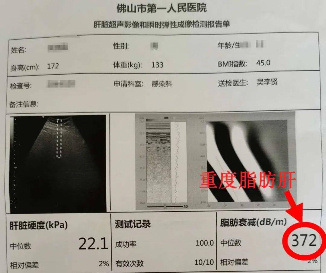 臀围125cm,血脂高,彩超提示重度脂肪肝,瞬时弹性提示:cap 372,硬度22