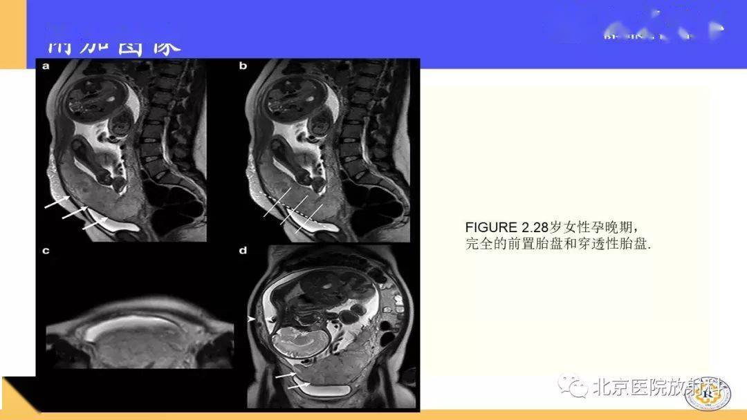 共振成像(mri)在評估胎盤中的作用:主題:胎盤從正常變異到植入異常與