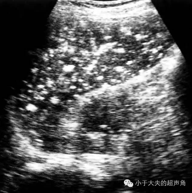 【超声随响】第14期 脾结核 splenic tuberculosis