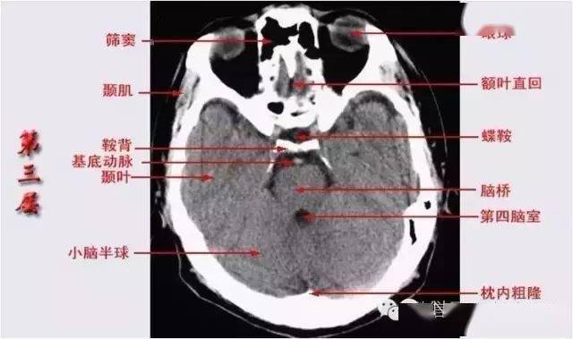 乙状窦位置在哪里图片图片