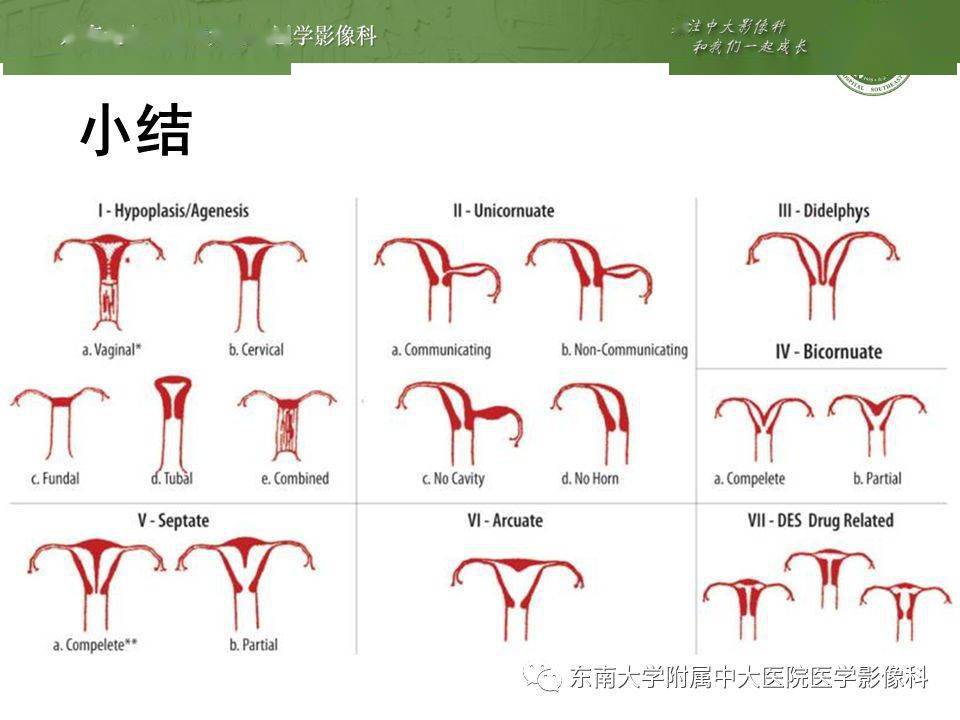 mr平掃編輯/校對:王焱鈞病例結果:完全性縱隔子宮(手術證實)返回搜狐