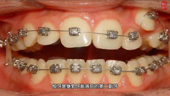 牙齿矫正的过程暴牙妹在两年内变一个样牙医是怎样做到的