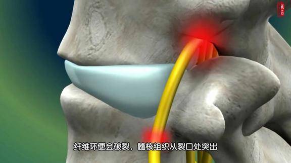 腰间盘突出手术演示动画十个腰疼腿疼九个腰间盘突出