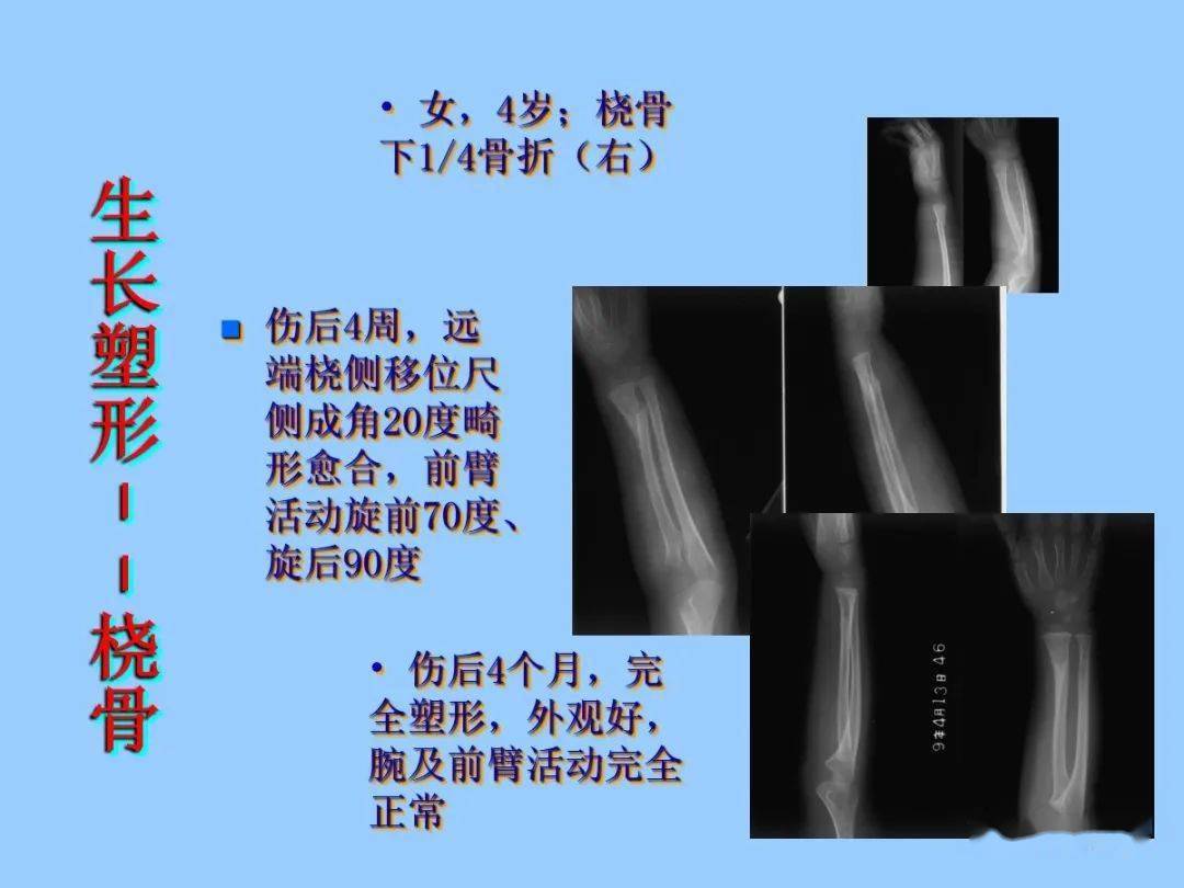 儿童骨折塑形能力图图片