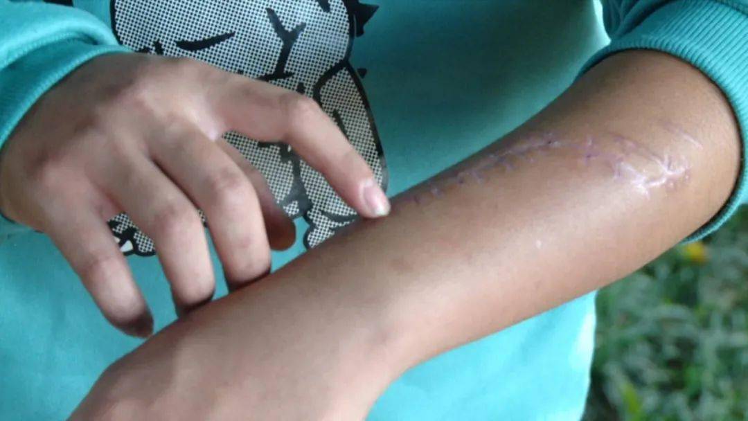 为制止电瓶车惯偷作案广西一小伙凌晨追贼被砍成蜈蚣手