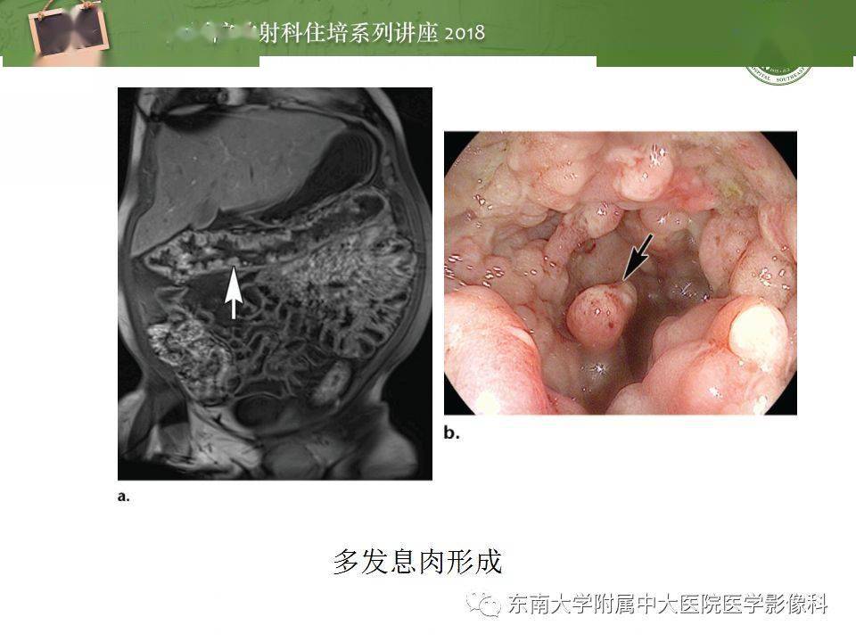 組織病理學:粘膜下固有層增厚伴慢性炎症細胞浸潤,隱窩結構扭曲