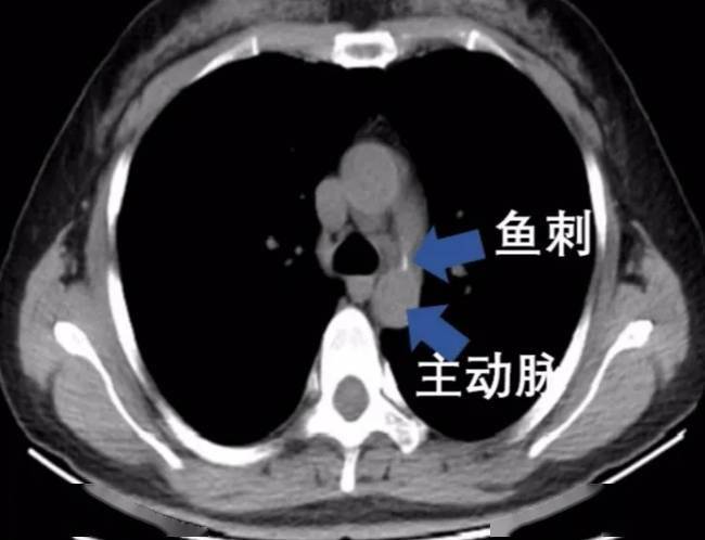 强咽鱼刺差点刺破主动脉,喝醋咽饭处理"骨鲠在喉"可能会"要命"