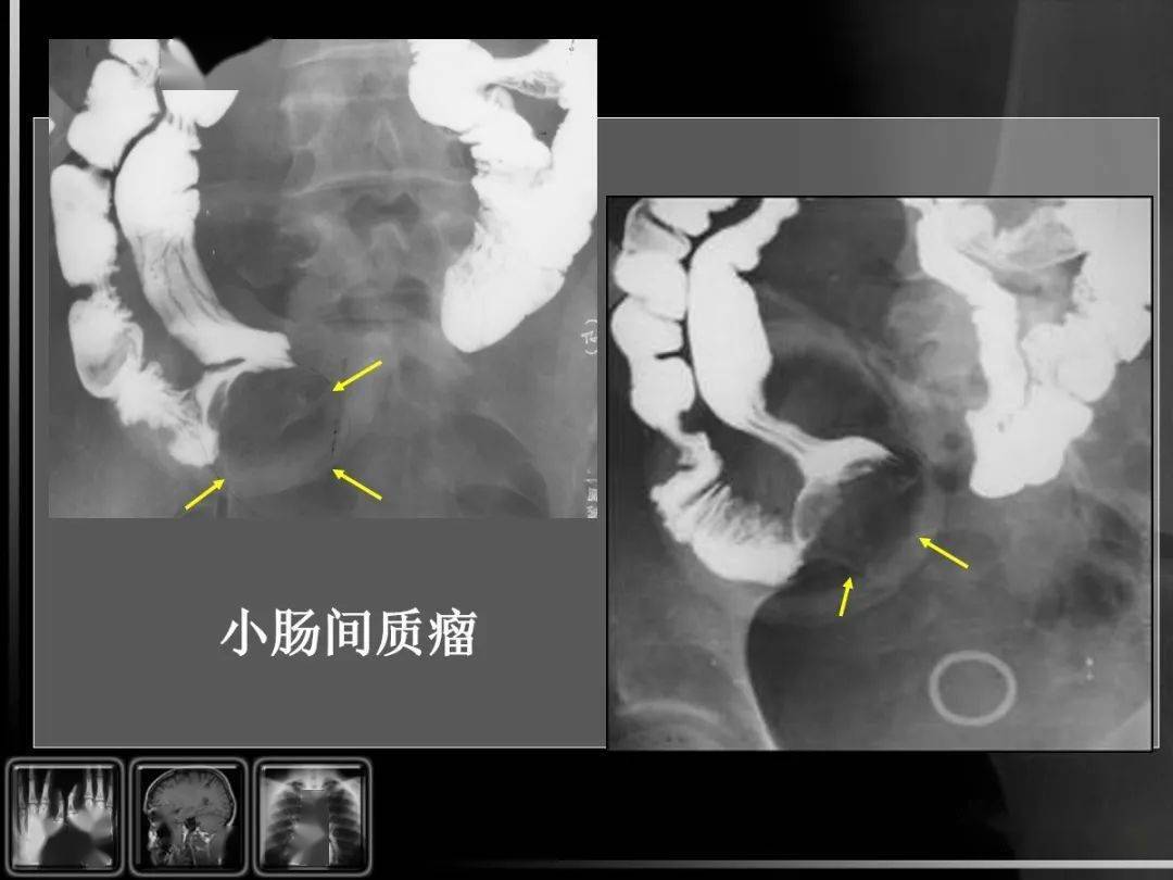 消化道疾病影像诊断与鉴别_造影
