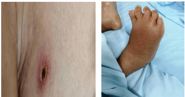 很快,科室主任在患者右侧腋前乳房处发现有一恙虫叮咬过后的焦痂,再反