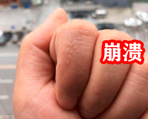 关于汗疱疹可以涂身体乳吗的信息