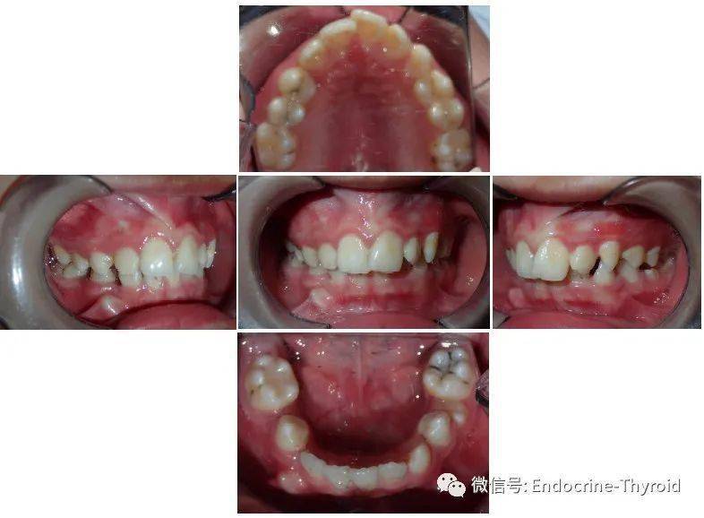 入院后,医生发现童童除矮小和生长发育迟缓之外,还有牙齿排列不齐及