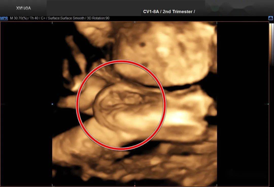 胎儿大腿淋巴管瘤