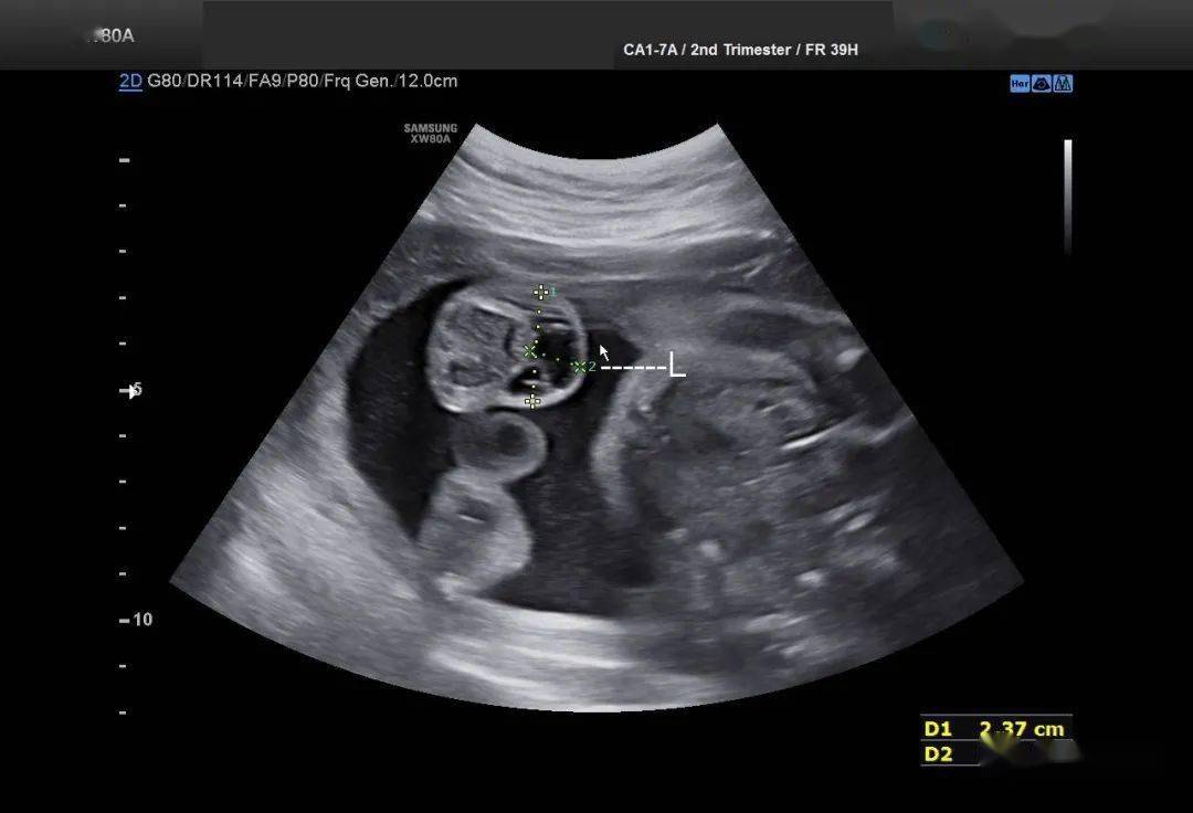 胎儿大腿淋巴管瘤