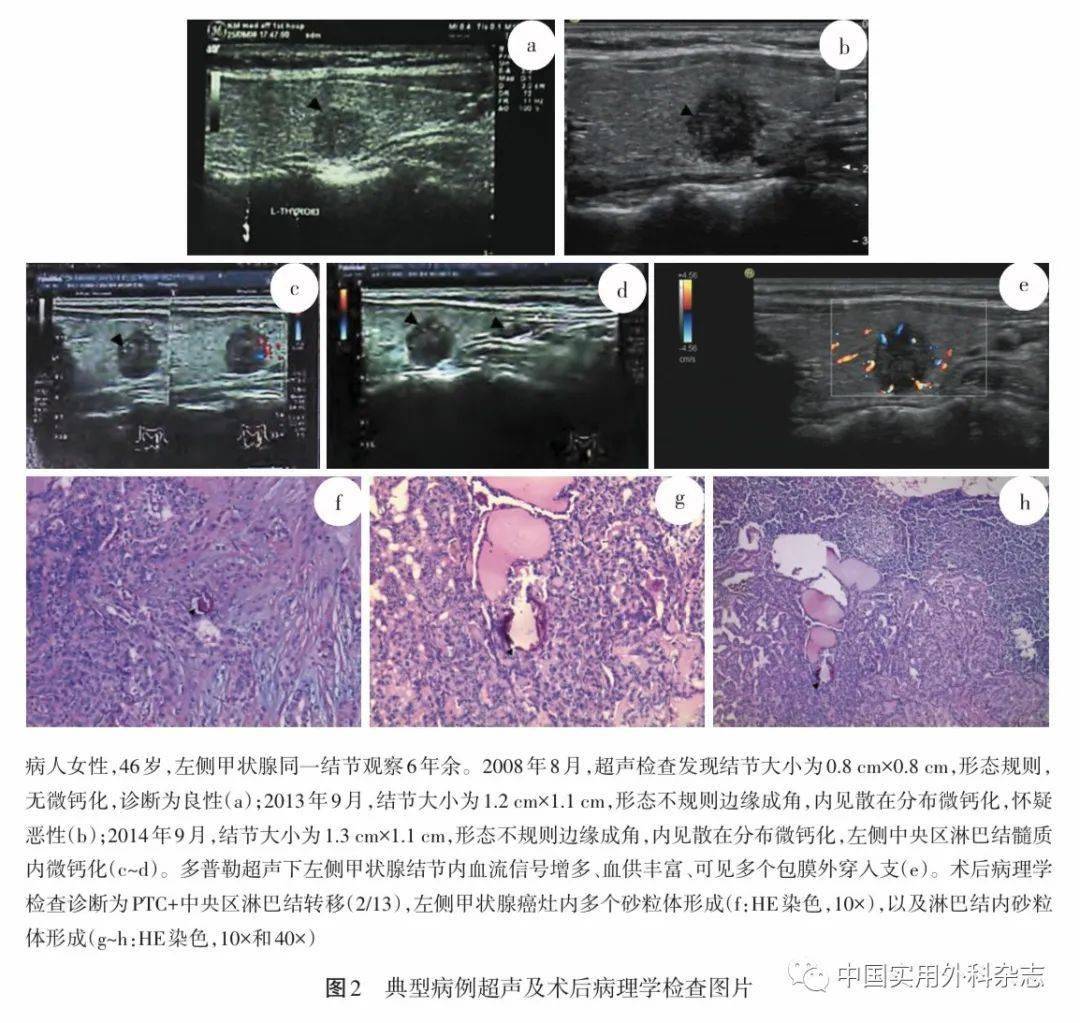 论著|术前临床及超声检查特征对甲状腺乳头状癌中央区淋巴结转移预测