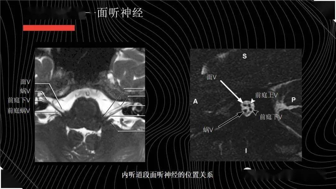 面神经管ct解剖图图片