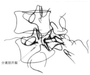 病例腰椎真性与假性滑脱如何鉴别假性滑脱如何治疗