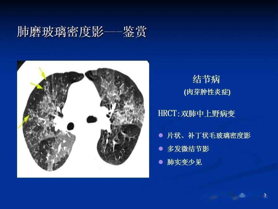 读片基础肺部弥漫性磨玻璃密度影的影像表现