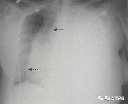 包裹性积液胸膜腔的粘连常常是由曾经的脓胸或血胸造成,可以限制胸腔