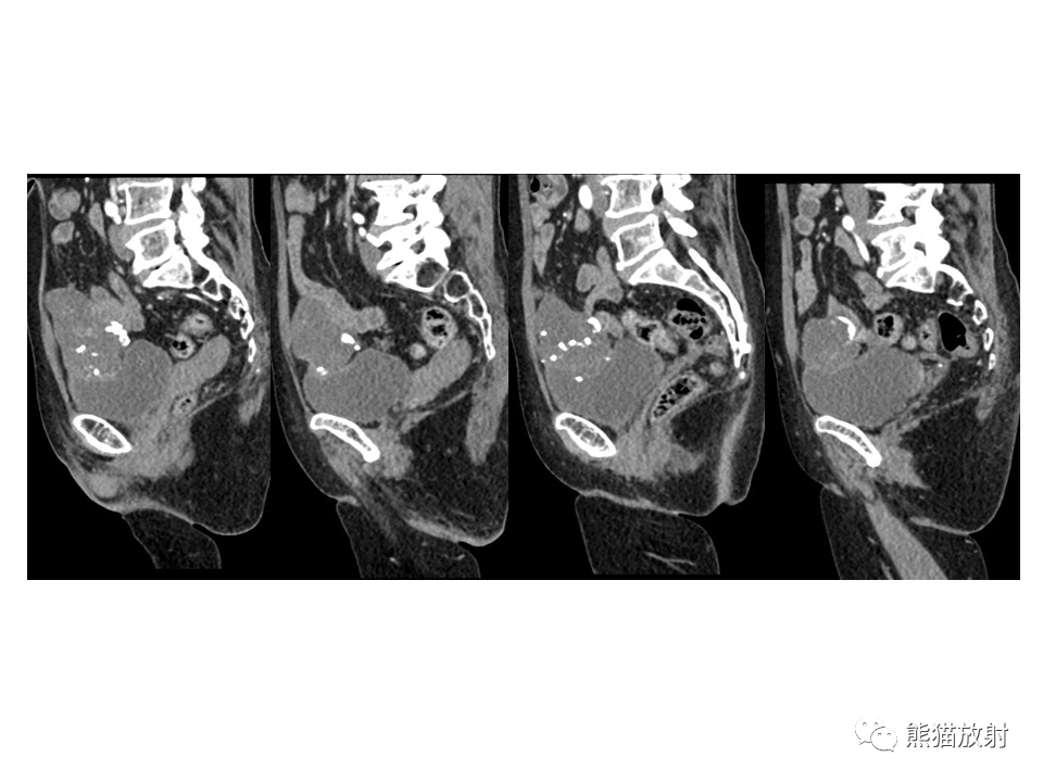 脐尿管癌,脐尿管脓肿↓ 相关内容链接:【专题】脐尿管畸形与脐尿管癌