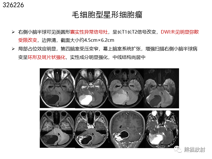 【省立影像读片】颅脑病变 20.10~_星形