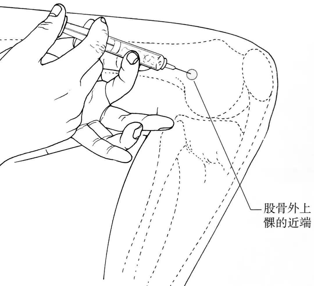 【深度好文】膝關節疼痛的診治,羅列的 8 個重要細節_運動