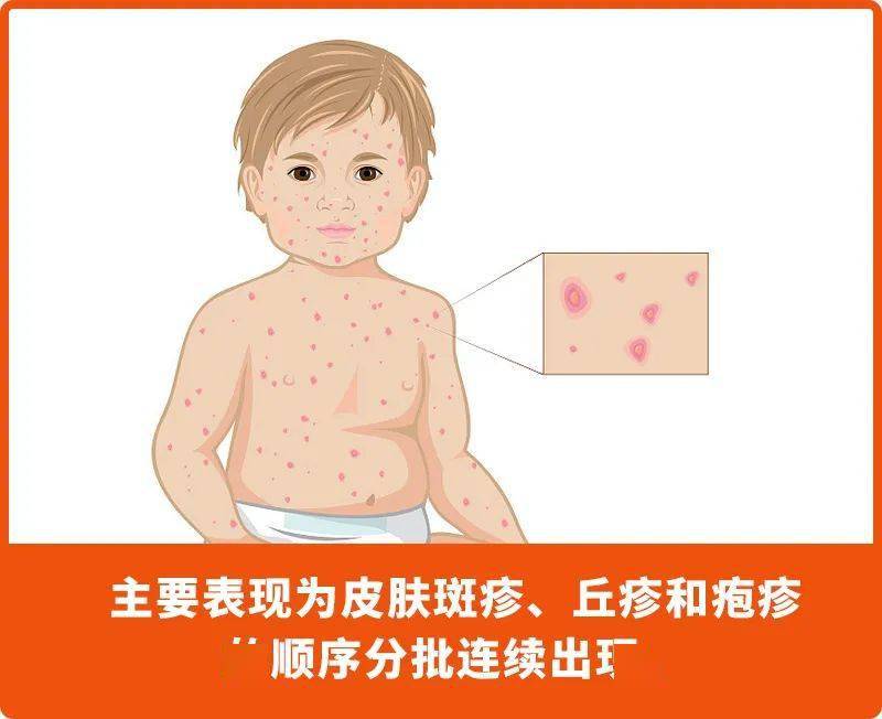 【健康】病毒界"老赖"来了,老少通吃,传染性还强_水痘