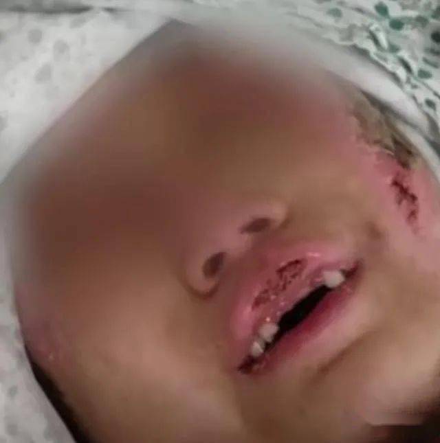 烫水浇头火烧嘴,6岁女童遭亲妈及其男友虐待险丧命_手机搜狐网