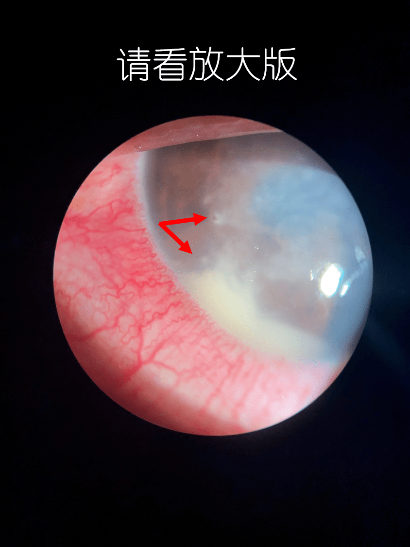 什么情况桂林有人吃板栗差点赔上一只眼睛