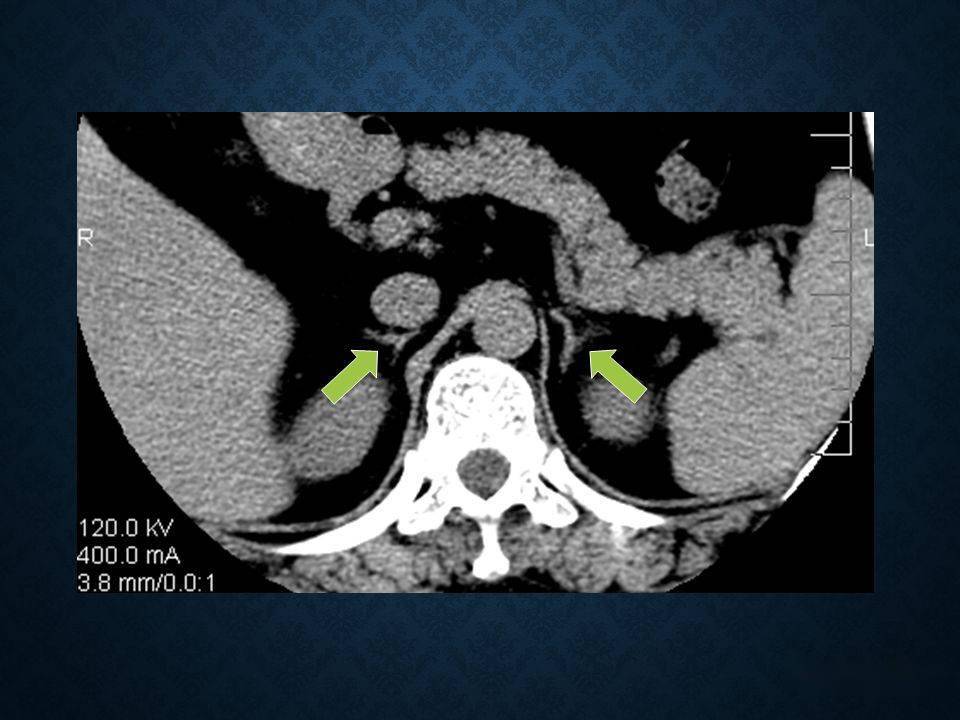 肾上腺丨扫描方案解剖皮质增生及小腺瘤的诊断